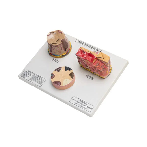 Buy Skin Cancer Acne Burn Model – ESAW Dermatology Educational Tool for Labs