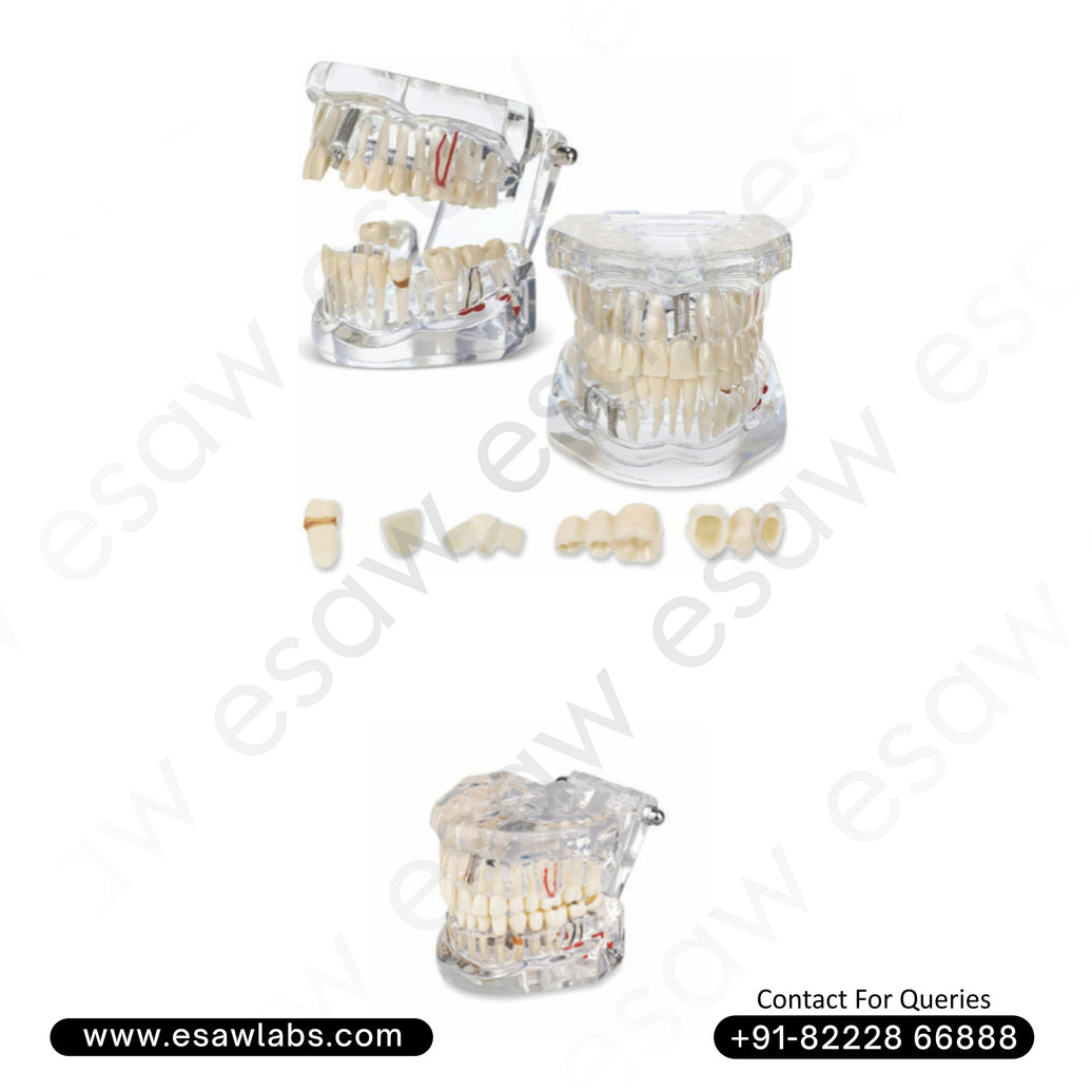 Transparent Dental Pathology Model – Life-Size Acrylic Tooth Model with Cavities, Implants & Root Canal Demonstration