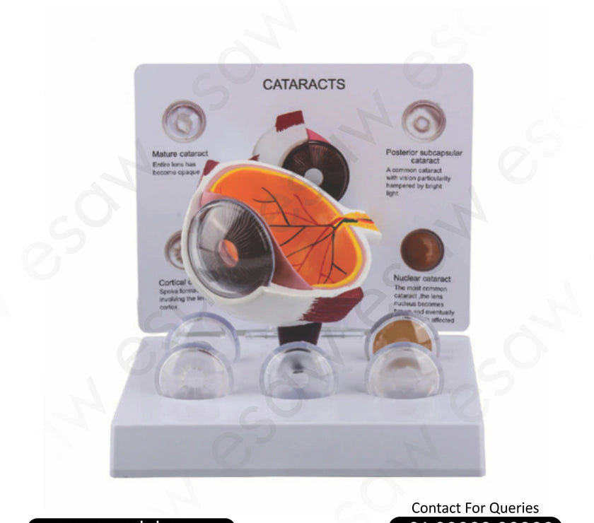 Buy Cataract Eye Model with 5 Interchangeable Lenses | Educational Ophthalmology Model – ESAW India&nbsp;