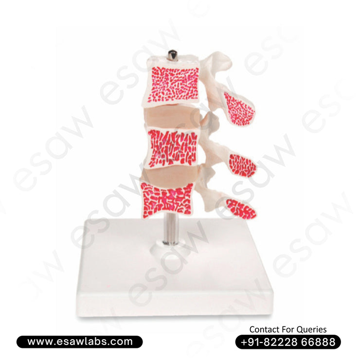 Cutaway Osteoporosis Model  | Buy Anatomical Bone Models in India &amp; Worldwide