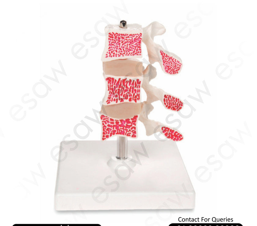 Cutaway Osteoporosis Model  | Buy Anatomical Bone Models in India &amp; Worldwide