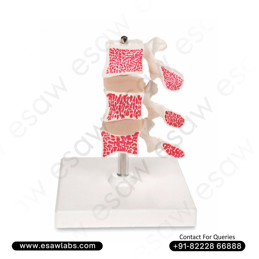 Cutaway Osteoporosis Model  | Buy Anatomical Bone Models in India &amp; Worldwide