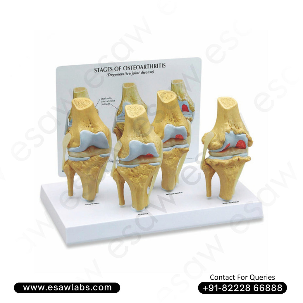 Knee Arthritis Model (Osteoarthritis – Knee Disease Model) – Set of 4 Degenerative Joint Models
