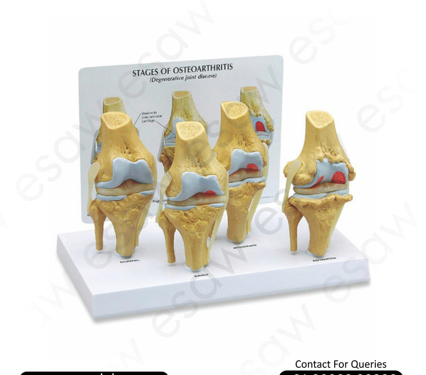 Knee Arthritis Model (Osteoarthritis – Knee Disease Model) – Set of 4 Degenerative Joint Models