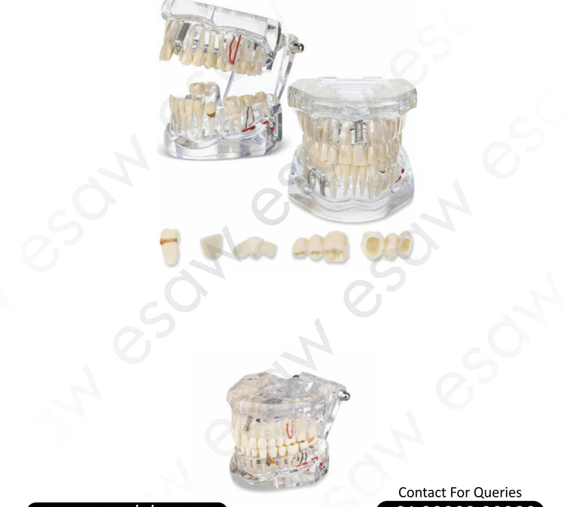 Transparent Dental Pathology Model – Life-Size Acrylic Tooth Model with Cavities, Implants &amp; Root Canal Demonstration