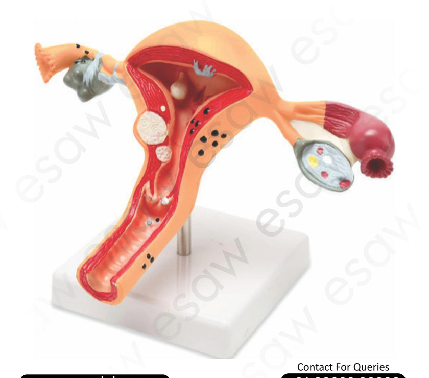 Uterus and Ovary Anatomy Model with Common Pathologies – Educational Female Reproductive Disease Model
